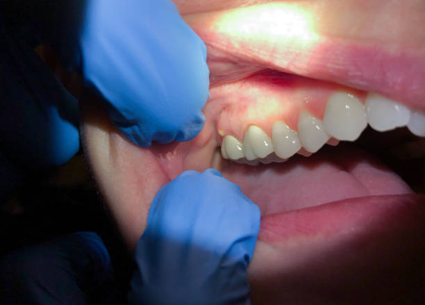 Best Dental Abscess Treatment in Homestead Valley, CA